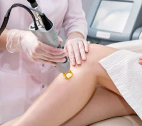 LASER HAIR REMOVAL